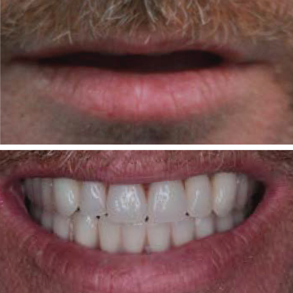 Dental transplant