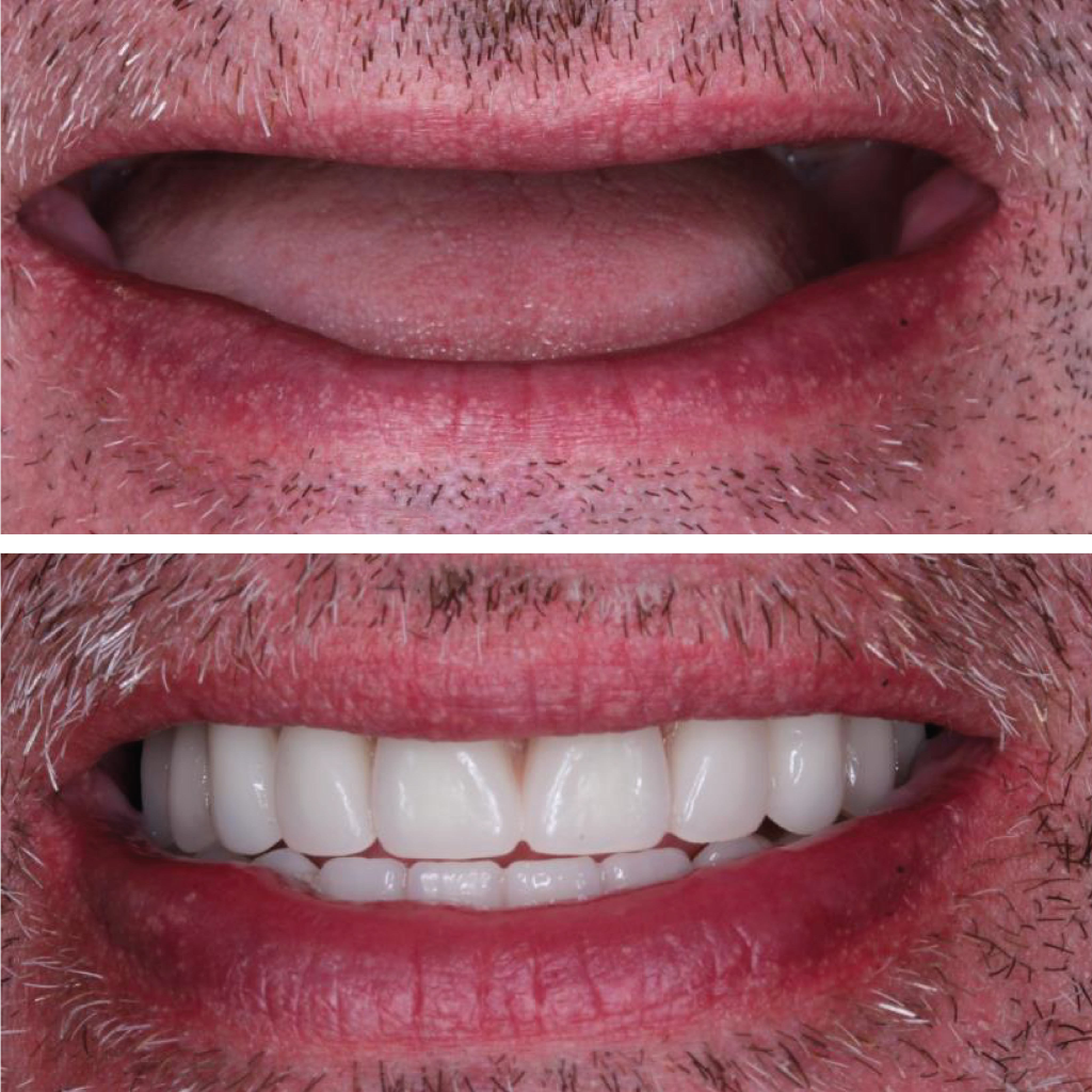 Dental transplant
