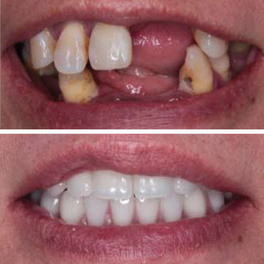 Dental Implants